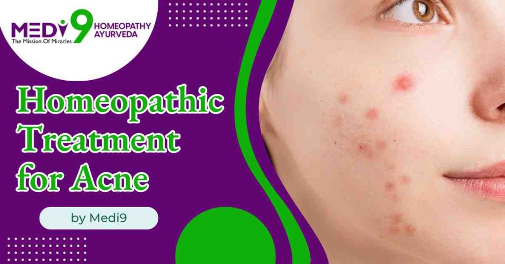 homeopathic treatment for acne