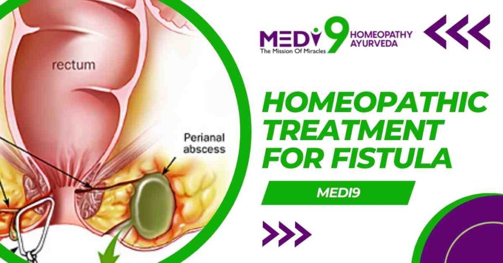 homeopathic treatment for fistula